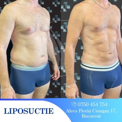 Rezultate lipo: înainte și după. Bărbat cu abdomen plat, după liposucție. Chirurgie estetică.