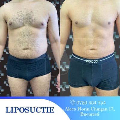 Rezultate lipoaspirație: înainte și după. Corp masculin, abdomen, chirurgie estetică.