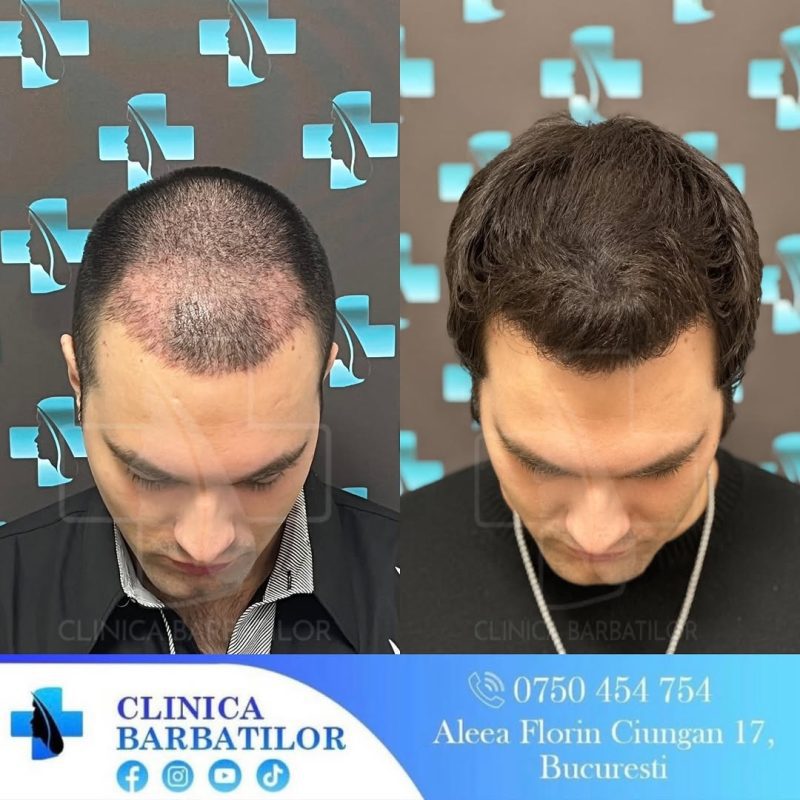 Rezultate transplant de păr. Înainte și după. Tratament alopecie masculină. Clinica Bărbaților, București.