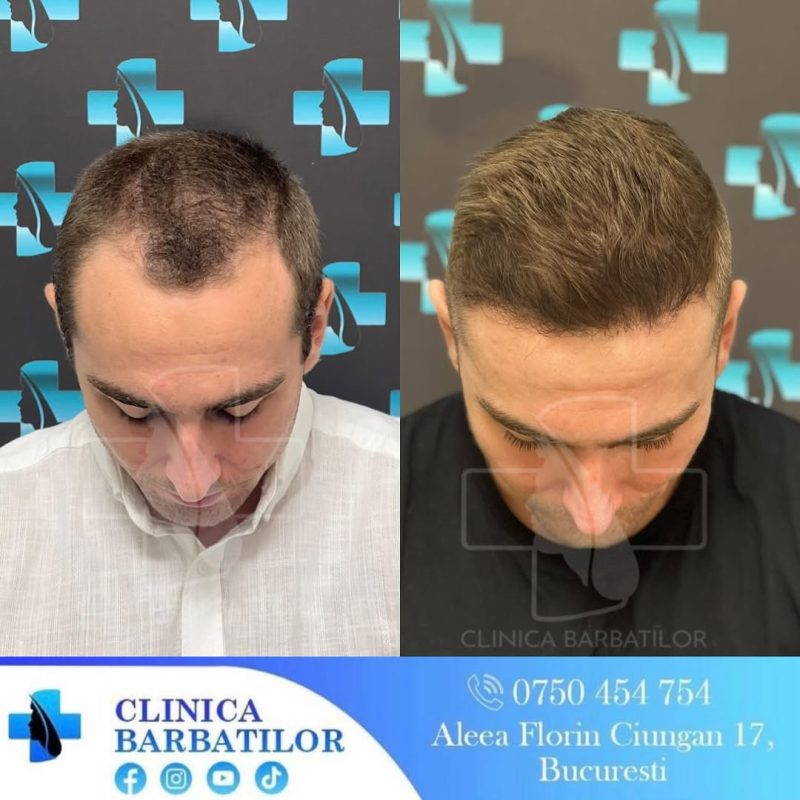 Rezultate transplant de păr. Înainte și după la un bărbat. Clinică specializată în transplant de păr.