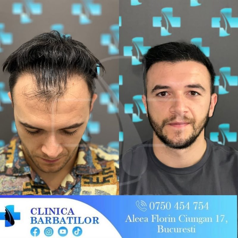 Rezultate transplant de păr. Bărbat înainte și după tratament alopecie. Clinica Bărbaților București.