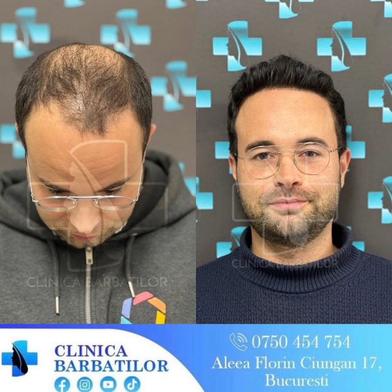 Rezultat transplant de păr. Bărbat înainte și după procedura de restaurare a părului. Clinică specializată în transplant păr.