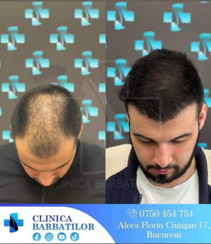Rezultate transplant de păr. Înainte și după procedura la Clinica Bărbaților, București. Tratament alopecie.