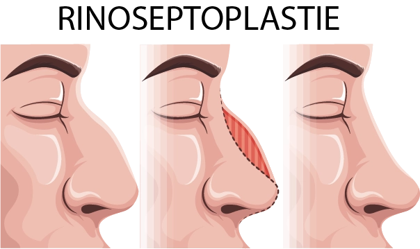 Ilustrație rinoplastie: înainte, intervenție chirurgicală, după. Procedură estetică nas, îmbunătățire aspect.