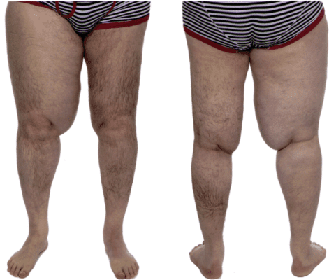 liposuctie picioare