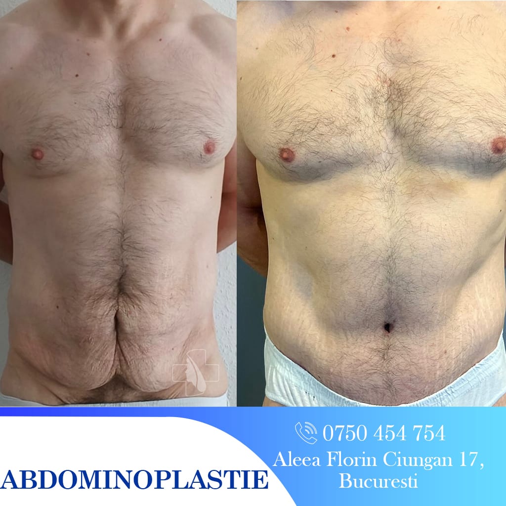 Abdominoplastie-rezultat