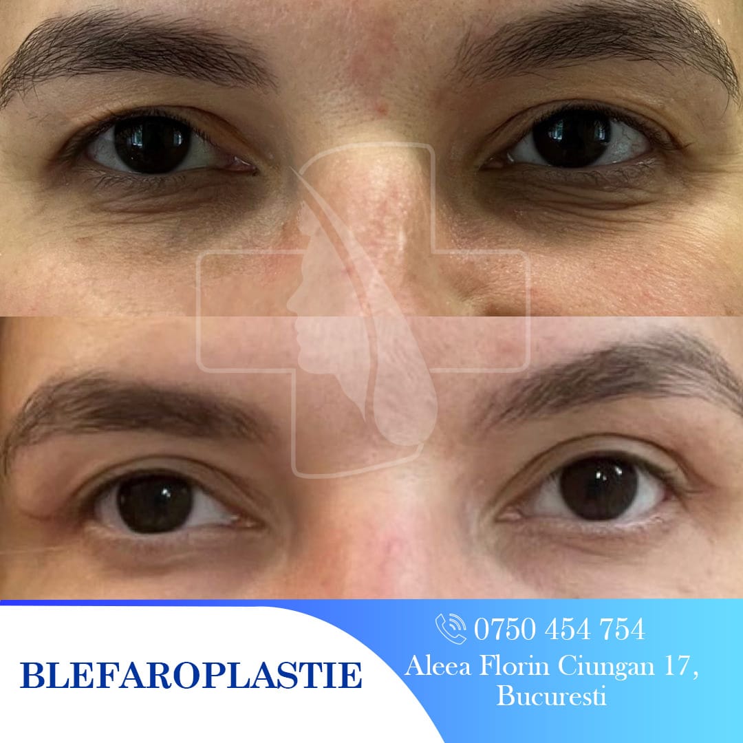 Rezultate blefaroplastie: Ochi înainte și după operație. Estetică facială, pleoape mai tinere.