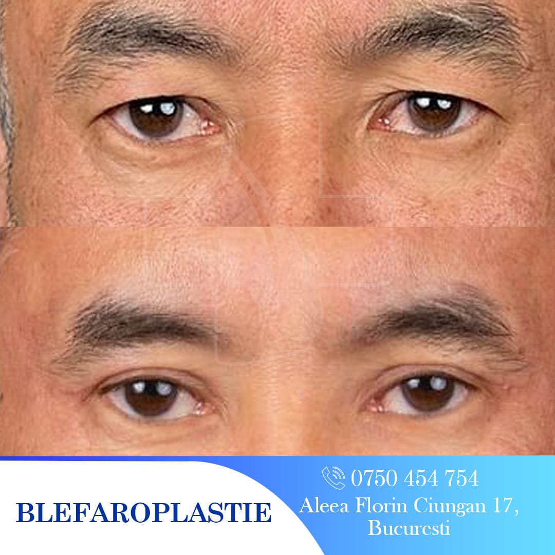Rezultate blefaroplastie: înainte și după. Ochi mai tineri, aspect îmbunătățit. Chirurgie estetică pleoape.