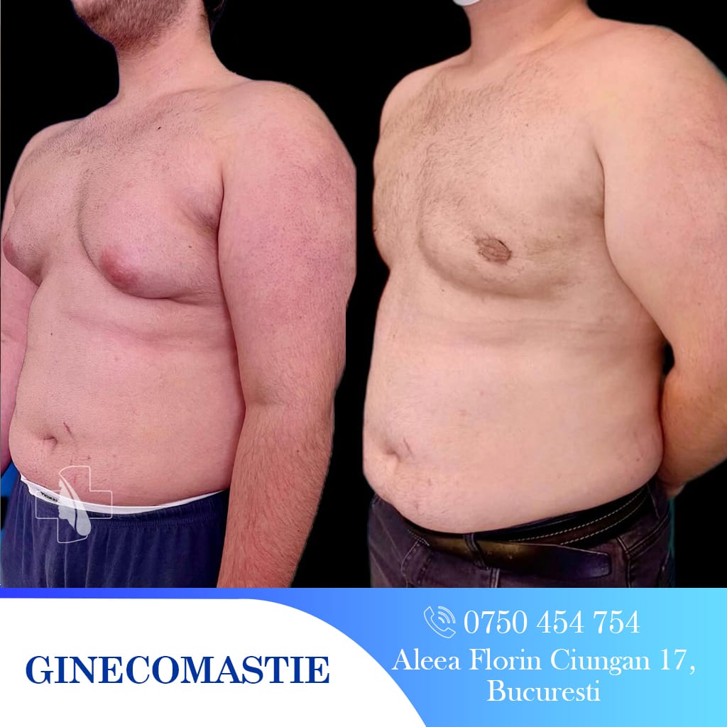 rezultat ginecomastie clinicabarbatilor 2