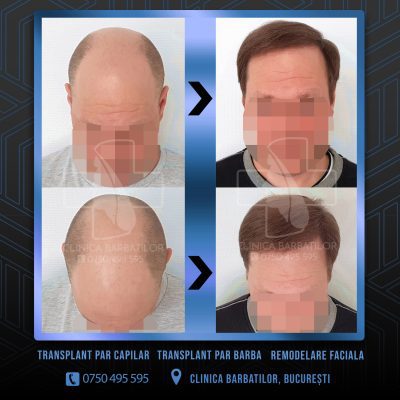 Rezultat Transplant de par. Persoana care are alopecie androgenetica a facut o interventie la clinica noastra din Bucuresti si acesta este rezultatul