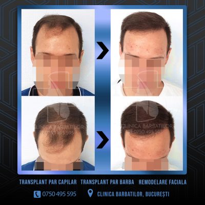 Rezultat Transplant de par. Persoana care are alopecie androgenetica a facut o interventie la clinica noastra din Bucuresti si acesta este rezultatul