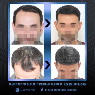 Rezultat Transplant de par. Persoana care are alopecie androgenetica a facut o interventie la clinica noastra din Bucuresti si acesta este rezultatul