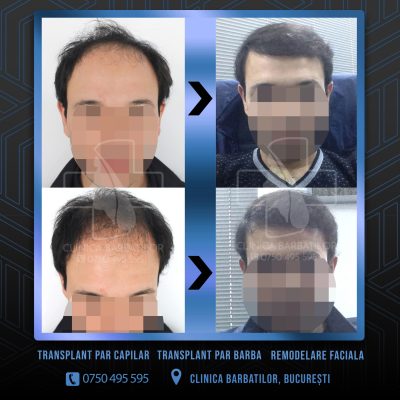 Rezultat Transplant de par. Persoana care are alopecie androgenetica a facut o interventie la clinica noastra din Bucuresti si acesta este rezultatul