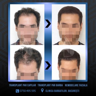 Rezultat Transplant de par. Persoana care are alopecie androgenetica a facut o interventie la clinica noastra din Bucuresti si acesta este rezultatul