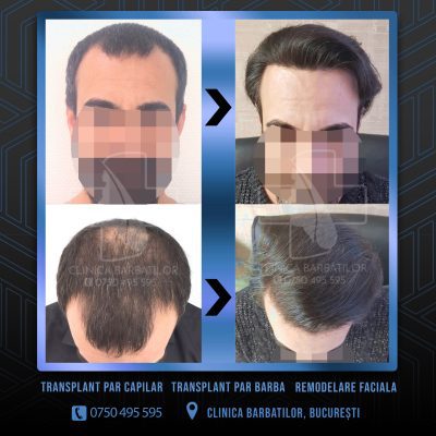 Rezultat Transplant de par. Persoana care are alopecie androgenetica a facut o interventie la clinica noastra din Bucuresti si acesta este rezultatul