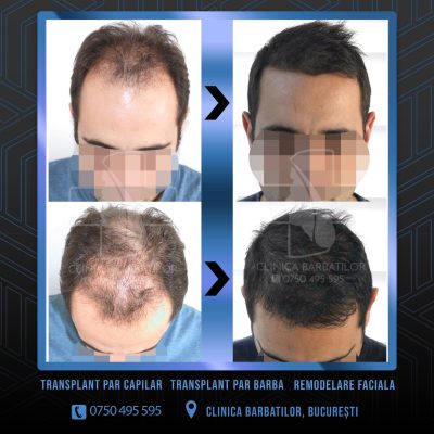 Rezultat Transplant de par. Persoana care are alopecie androgenetica a facut o interventie la clinica noastra din Bucuresti si acesta este rezultatul
