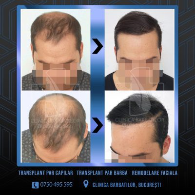 Rezultat Transplant de par. Persoana care are alopecie androgenetica a facut o interventie la clinica noastra din Bucuresti si acesta este rezultatul