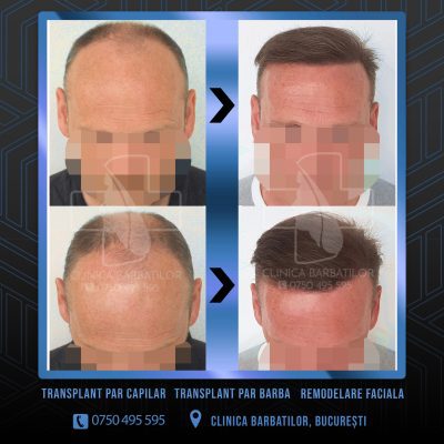 Rezultat Transplant de par. Persoana care are alopecie androgenetica a facut o interventie la clinica noastra din Bucuresti si acesta este rezultatul