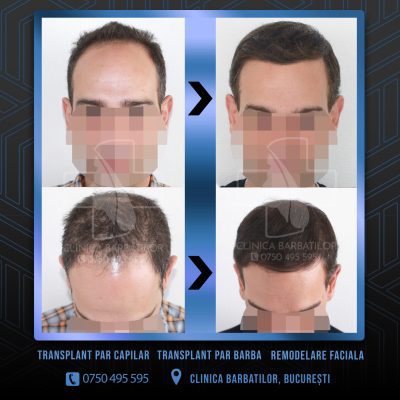 Rezultat Transplant de par. Persoana care are alopecie androgenetica a facut o interventie la clinica noastra din Bucuresti si acesta este rezultatul