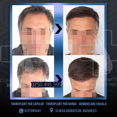Rezultat Transplant de par. Persoana care are alopecie androgenetica a facut o interventie la clinica noastra din Bucuresti si acesta este rezultatul