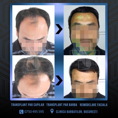 Rezultat Transplant de par. Persoana care are alopecie androgenetica a facut o interventie la clinica noastra din Bucuresti si acesta este rezultatul