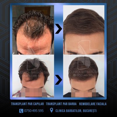 Rezultat Transplant de par. Persoana care are alopecie androgenetica a facut o interventie la clinica noastra din Bucuresti si acesta este rezultatul