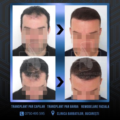 Rezultat Transplant de par. Persoana care are alopecie androgenetica a facut o interventie la clinica noastra din Bucuresti si acesta este rezultatul