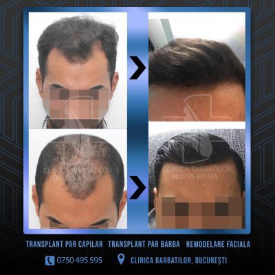 Rezultat Transplant de par. Persoana care are alopecie androgenetica a facut o interventie la clinica noastra din Bucuresti si acesta este rezultatul