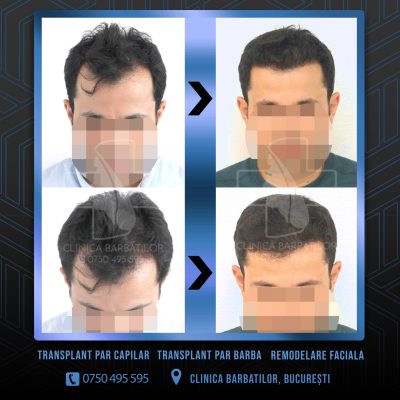 Rezultat Transplant de par. Persoana care are alopecie androgenetica a facut o interventie la clinica noastra din Bucuresti si acesta este rezultatul
