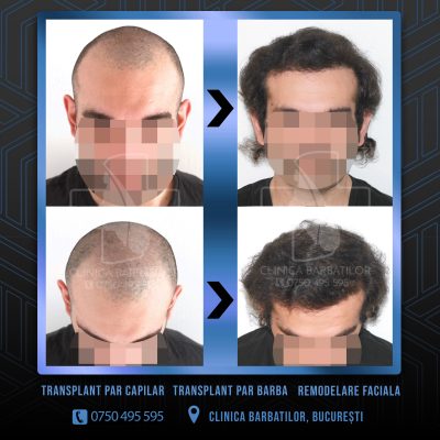Rezultat Transplant de par. Persoana care are alopecie androgenetica a facut o interventie la clinica noastra din Bucuresti si acesta este rezultatul