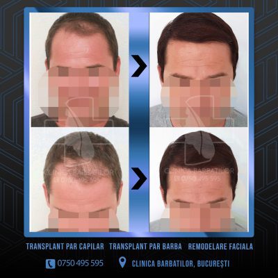 Rezultat Transplant de par. Persoana care are alopecie androgenetica a facut o interventie la clinica noastra din Bucuresti si acesta este rezultatul