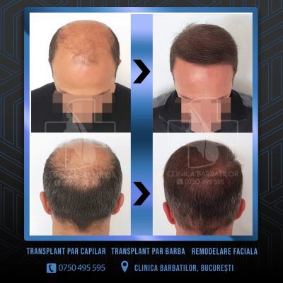 Rezultat Transplant de par. Persoana care are alopecie androgenetica a facut o interventie la clinica noastra din Bucuresti si acesta este rezultatul