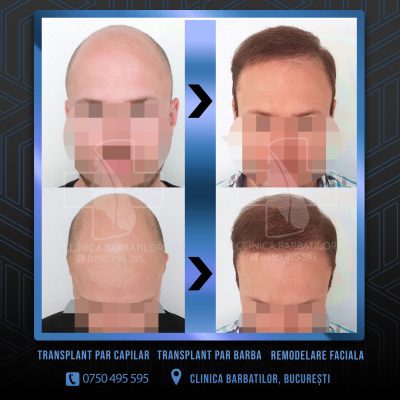 Rezultat Transplant de par. Persoana care are alopecie androgenetica a facut o interventie la clinica noastra din Bucuresti si acesta este rezultatul