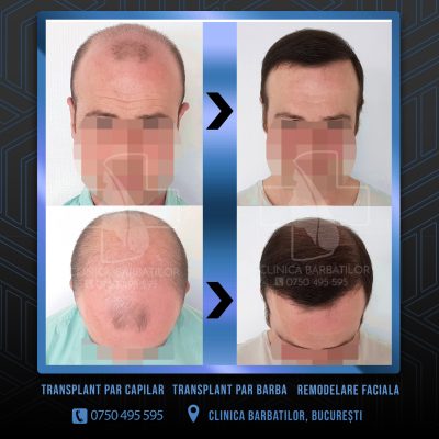 Rezultat Transplant de par. Persoana care are alopecie androgenetica a facut o interventie la clinica noastra din Bucuresti si acesta este rezultatul