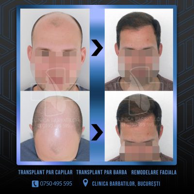 Rezultat Transplant de par. Persoana care are alopecie androgenetica a facut o interventie la clinica noastra din Bucuresti si acesta este rezultatul