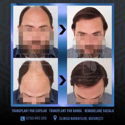 Rezultat Transplant de par. Persoana care are alopecie androgenetica a facut o interventie la clinica noastra din Bucuresti si acesta este rezultatul