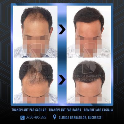 Rezultat Transplant de par. Persoana care are alopecie androgenetica a facut o interventie la clinica noastra din Bucuresti si acesta este rezultatul