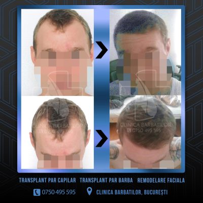 Rezultat Transplant de par. Persoana care are alopecie androgenetica a facut o interventie la clinica noastra din Bucuresti si acesta este rezultatul