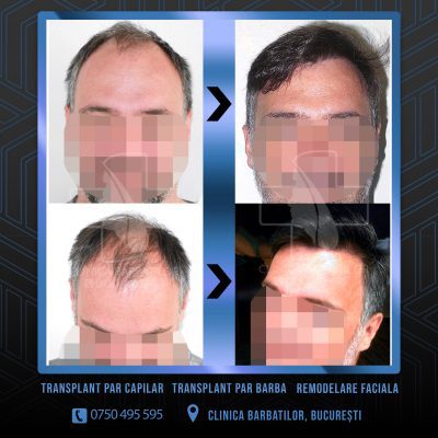 Rezultat Transplant de par. Persoana care are alopecie androgenetica a facut o interventie la clinica noastra din Bucuresti si acesta este rezultatul