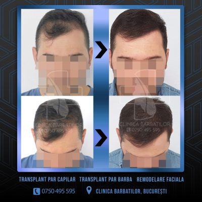 Rezultat Transplant de par. Persoana care are alopecie androgenetica a facut o interventie la clinica noastra din Bucuresti si acesta este rezultatul