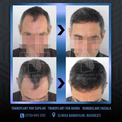 Rezultat Transplant de par. Persoana care are alopecie androgenetica a facut o interventie la clinica noastra din Bucuresti si acesta este rezultatul