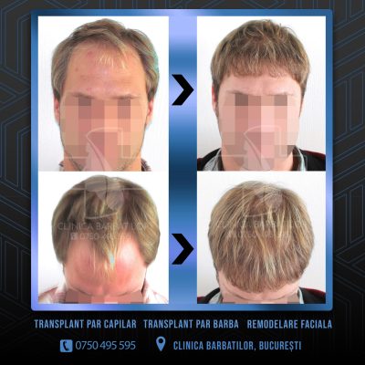 Rezultat Transplant de par. Persoana care are alopecie androgenetica a facut o interventie la clinica noastra din Bucuresti si acesta este rezultatul