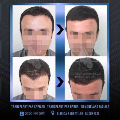 Rezultat Transplant de par. Persoana care are alopecie androgenetica a facut o interventie la clinica noastra din Bucuresti si acesta este rezultatul