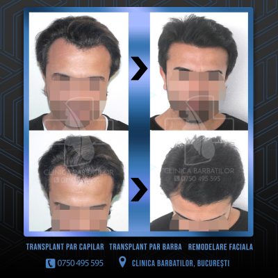 Rezultat Transplant de par. Persoana care are alopecie androgenetica a facut o interventie la clinica noastra din Bucuresti si acesta este rezultatul