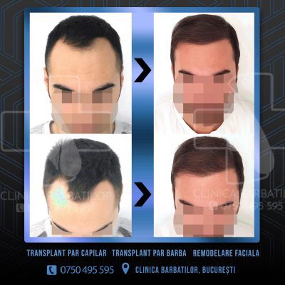 Rezultat Transplant de par. Persoana care are alopecie androgenetica a facut o interventie la clinica noastra din Bucuresti si acesta este rezultatul