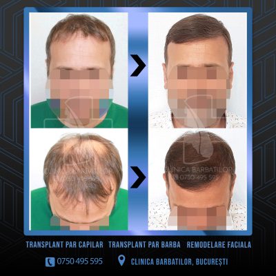 Rezultat Transplant de par. Persoana care are alopecie androgenetica a facut o interventie la clinica noastra din Bucuresti si acesta este rezultatul