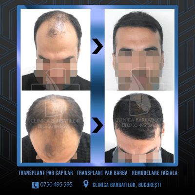 Rezultat Transplant de par. Persoana care are alopecie androgenetica a facut o interventie la clinica noastra din Bucuresti si acesta este rezultatul