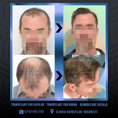 Rezultat Transplant de par. Persoana care are alopecie androgenetica a facut o interventie la clinica noastra din Bucuresti si acesta este rezultatul