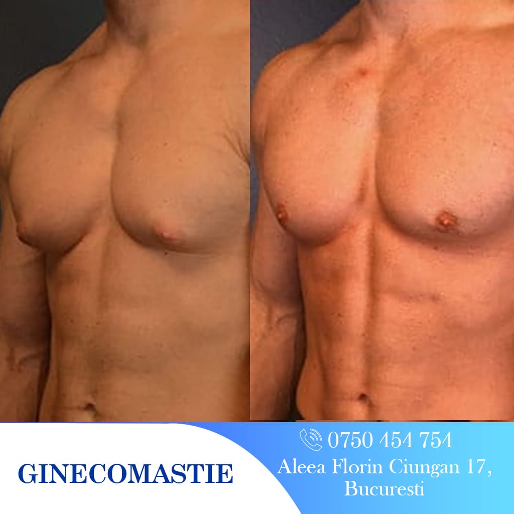 rezultat2 ginecomastie clinicabarbatilor 2