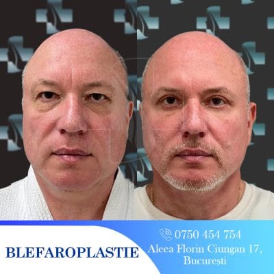 Rezultat blefaroplastie: înainte și după. Chirurgie estetică pleoape, îmbunătățire aspect.
